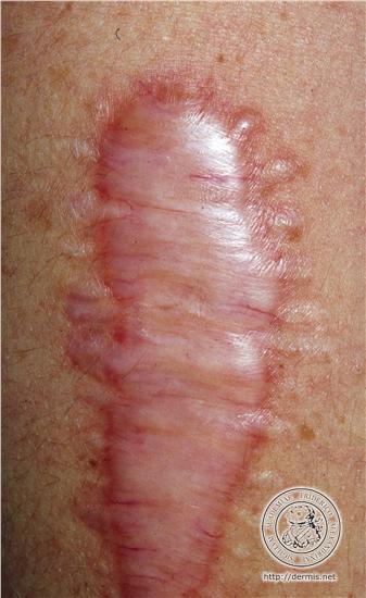 Cerederm Pansement cicatrisant : cicatrice hypertrophique, cheloide