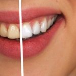 Comment avoir des dents blanches?