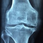 Traitement de l’arthrose et des douleurs rhumatismales
