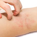 Eczema, dermatite atopique